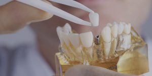 Implant dentaire